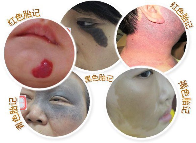 胎记治疗：寻找适合自己的方法与途径