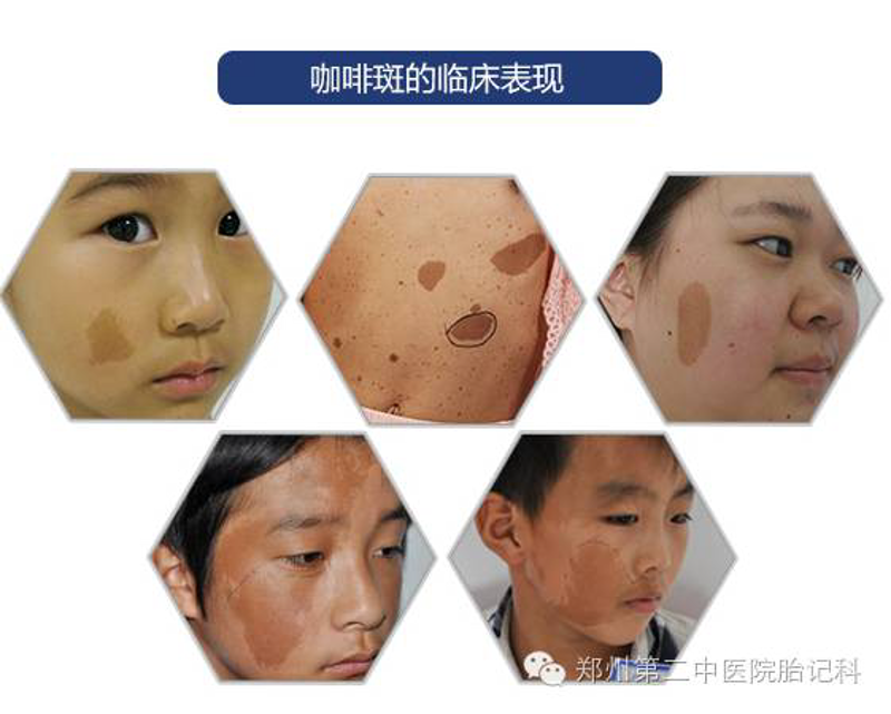 胎记治疗新进展：让美丽与健康同行！