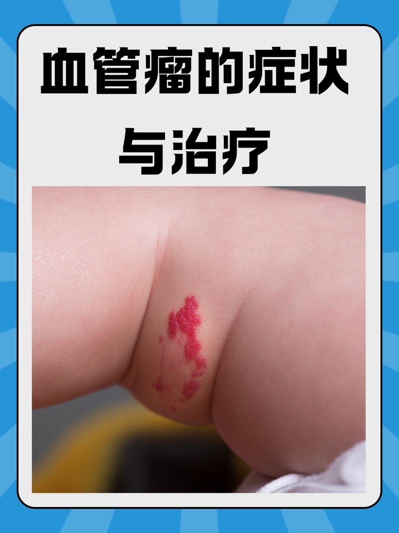 太田痣治疗：医学前沿与护理进阶