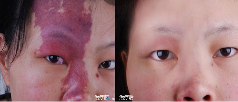 广州胎记医院：破解肌肤难题的新篇章