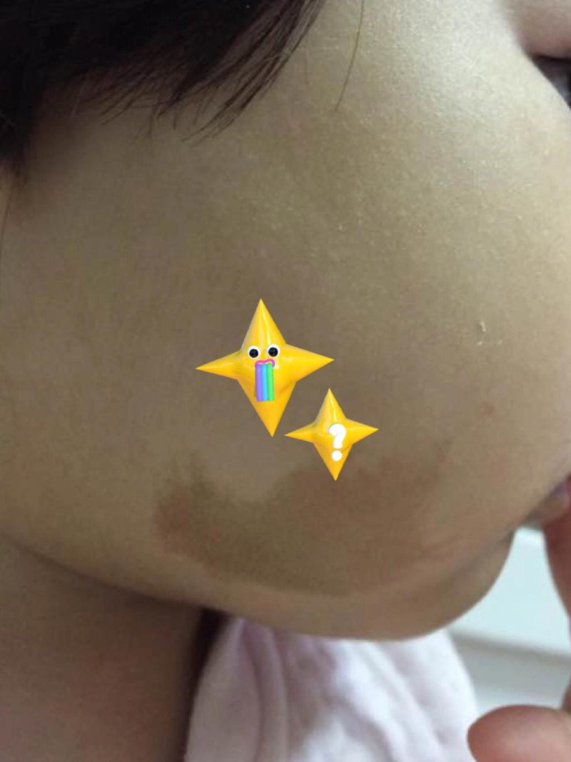 胎记治疗：选择广州的专业医院