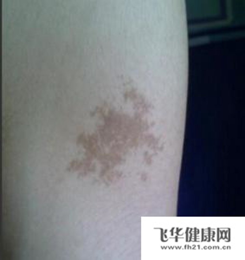 广州胎记医院：破解肌肤难题的新篇章
